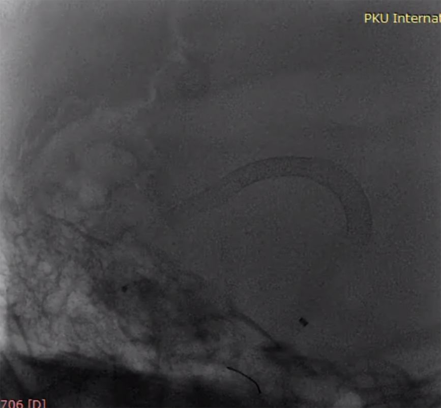 物华天宝·第7期｜脑部长型巨大夹层动脉瘤的4个密网支架桥接治疗复查治愈（附复查CTA结果）