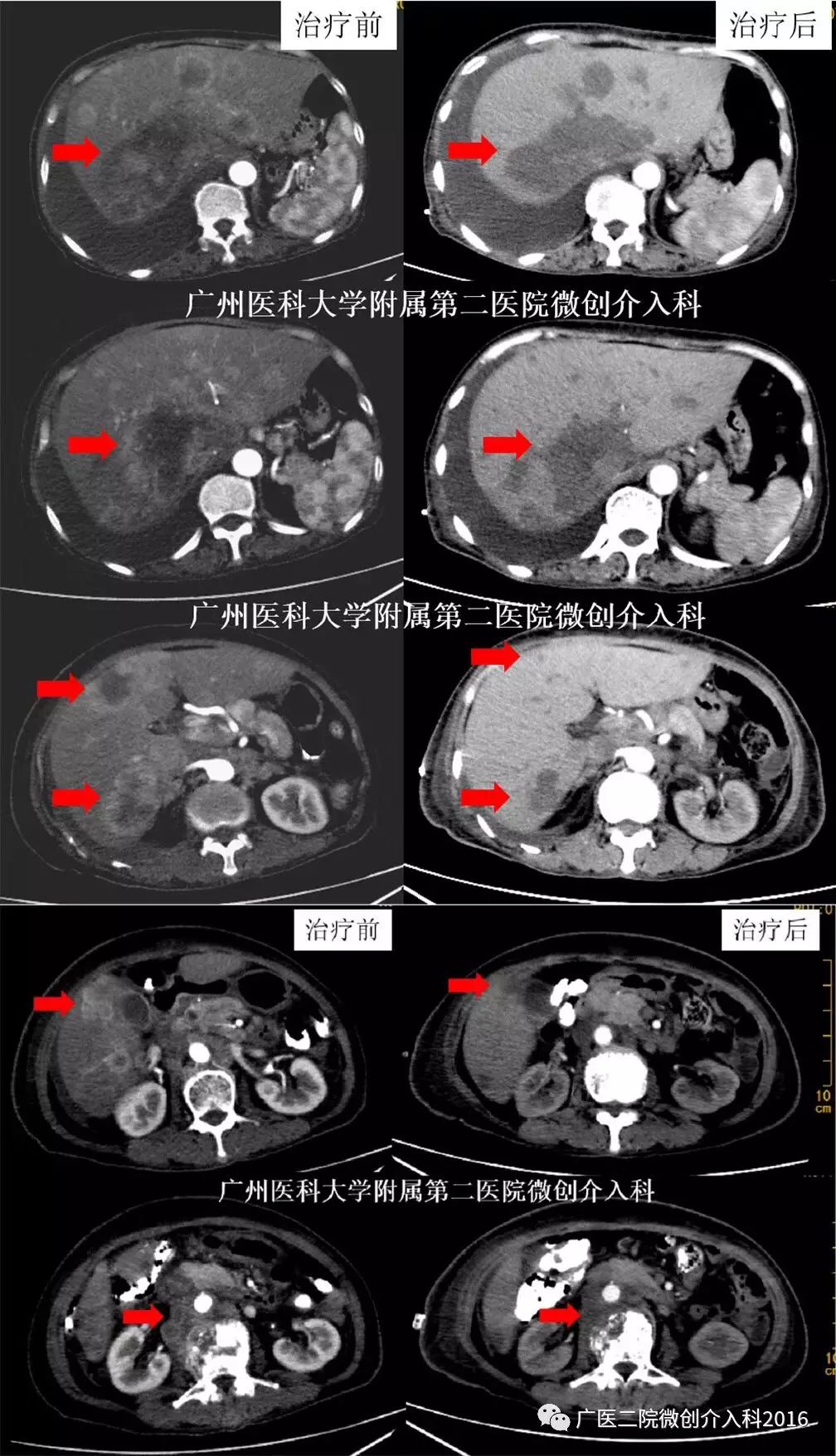 精准介入治疗效果好吗,精准免疫治疗最新消息