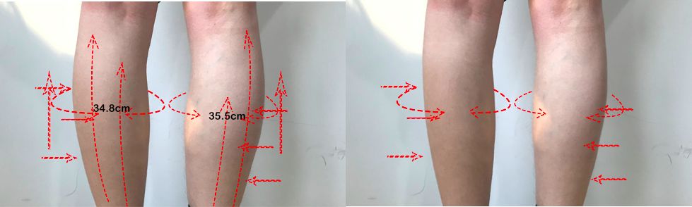 跑完步脚底板很痛但没有起泡,跑完步脚底板一踩就疼怎么回事