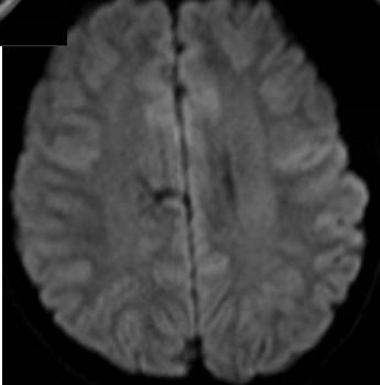 Rasmussen脑炎、结核性肉芽肿、脑发育性静脉畸形丨3分钟读片·第13期,下）