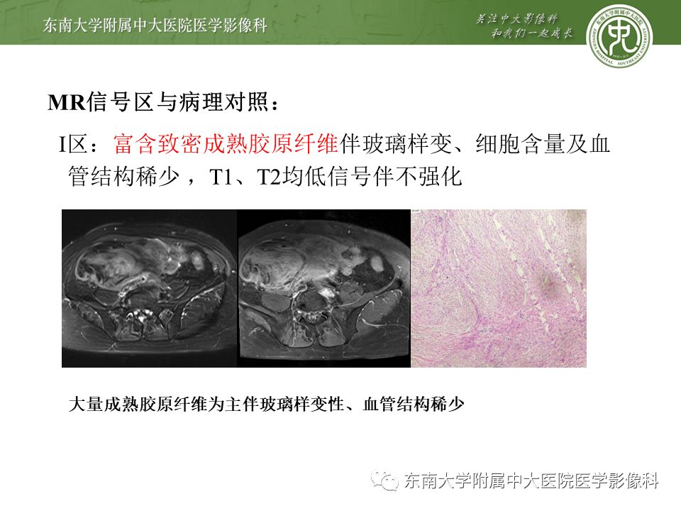 侵袭性纤维瘤影像学表现,侵袭性纤维瘤病影像上易诊断吗