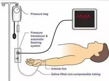 icu病房怎么监护,icu床边ct有影响吗