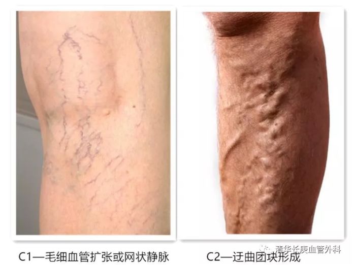 静脉曲张怎么保护好腿,夏季静脉曲张护腿