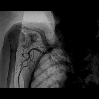 冠脉造影技术成熟不,跟我学技术分析从入门到精通
