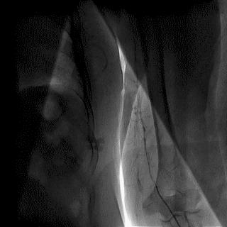 冠脉造影技术成熟不,跟我学技术分析从入门到精通