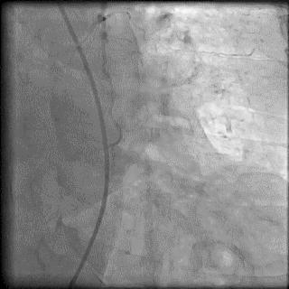 冠脉造影技术成熟不,跟我学技术分析从入门到精通
