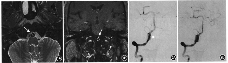 夜读：动脉的夹层，就仿佛是人生的夹缝