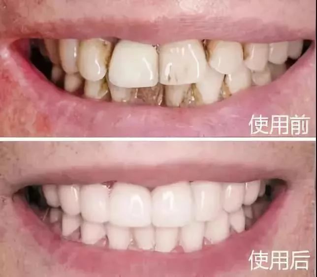 去除黄牙牙垢的牙膏,去口臭黄牙牙垢的牙膏