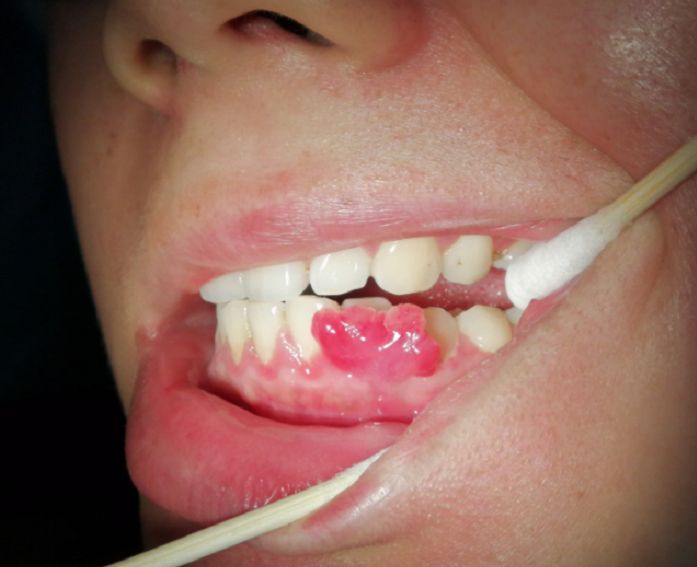 孕27周牙龈肿痛怎么办,准妈妈孕晚期出现牙龈瘤