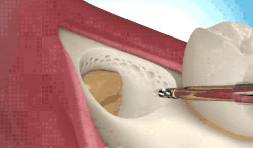 拔智齿的全过程科普,拔智齿细致操作过程