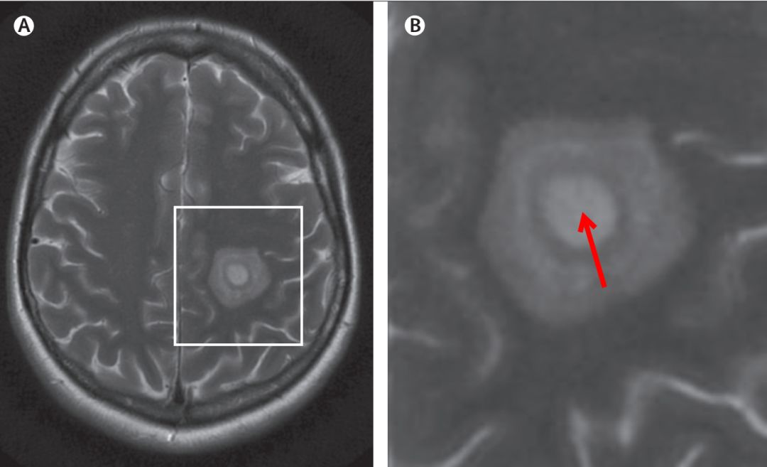 Whipple病、纹状体手、神经结节病、脱髓鞘假瘤丨3分钟读片·第16期