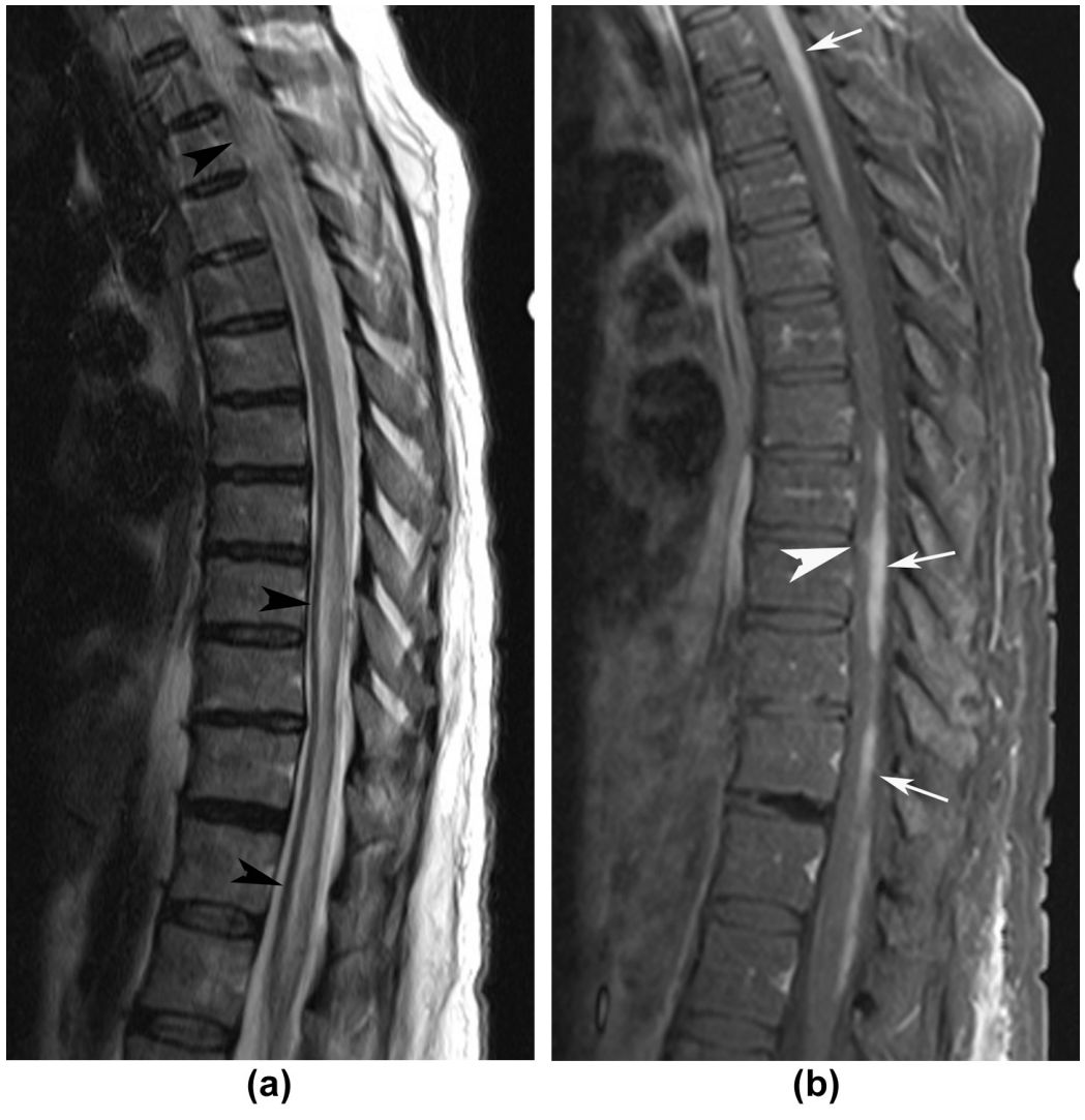 Whipple病、纹状体手、神经结节病、脱髓鞘假瘤丨3分钟读片·第16期