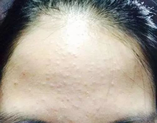 哪个牌子的壬二酸凝胶好,首博尔壬二酸清痘凝胶副作用