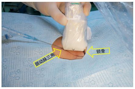 围术期中心静脉监测的专家共识（2017版）