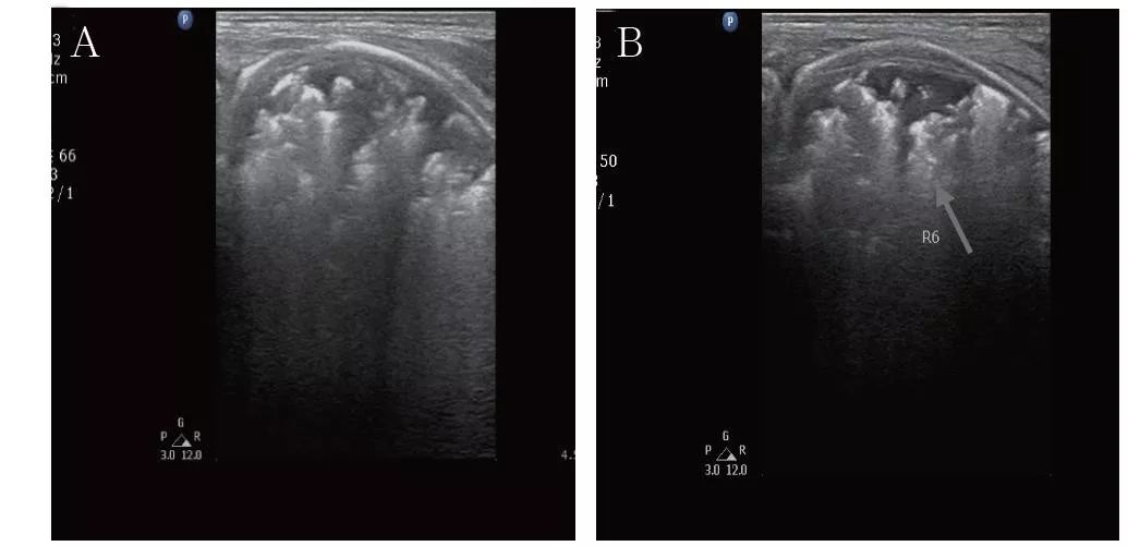 新生儿发热出汗,新生儿腹胀吐黄色液体