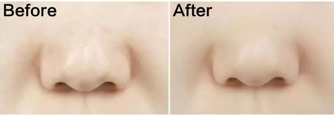 拒绝草莓鼻夹子夹出粉刺,拒绝草莓鼻毛孔粗大