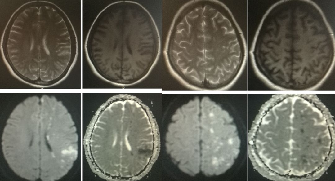 矛盾反应、Carney综合征、脑梗死、笑气中毒丨3分钟读片·第19期
