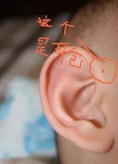 耳朵上有一个小洞是不是代表聪明,耳朵上的小洞能好吗