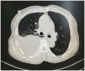 胸腔积液中医诊断是什么,胸外科微创治疗胸腔积液