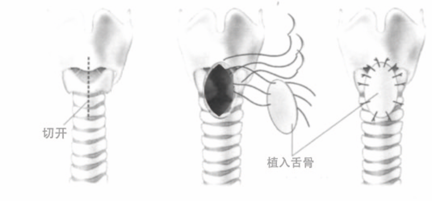 上海儿童医学中心气道狭窄,儿童气道狭窄怎么治疗