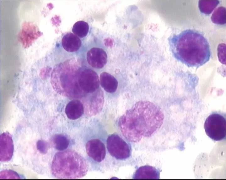 全血细胞减少疾病，你还傻傻分不清？