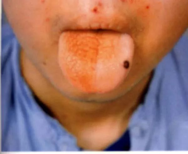 全血细胞减少疾病，你还傻傻分不清？