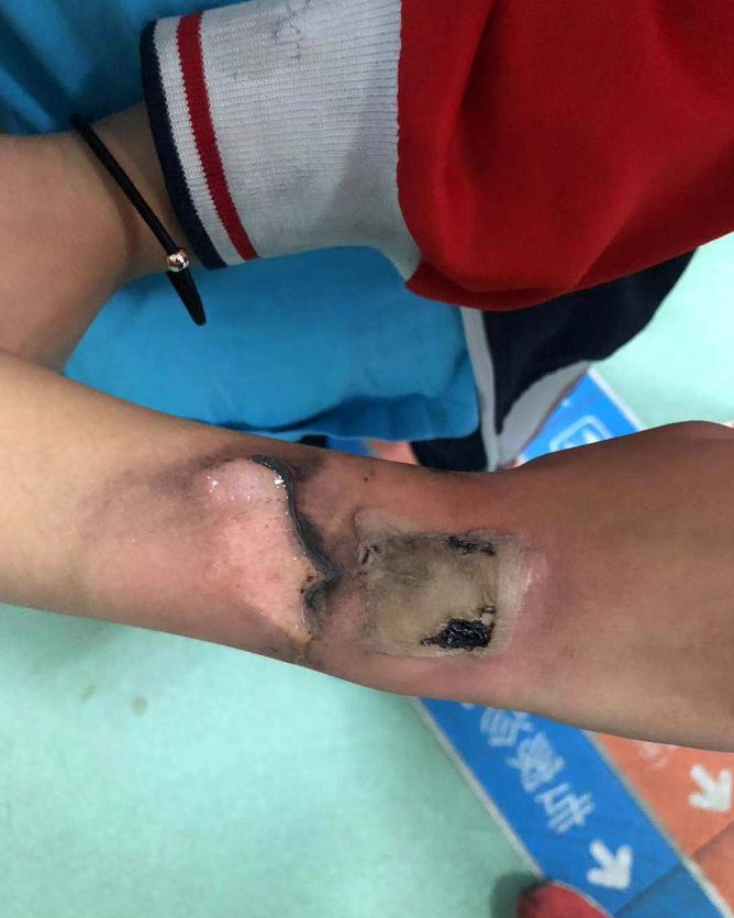 @荆门人,你家孩子经常戴的这东西出事了