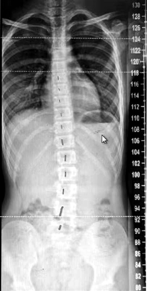 15岁女孩脊柱侧弯最好的恢复方法,13岁女孩脊柱侧弯恢复来得及吗