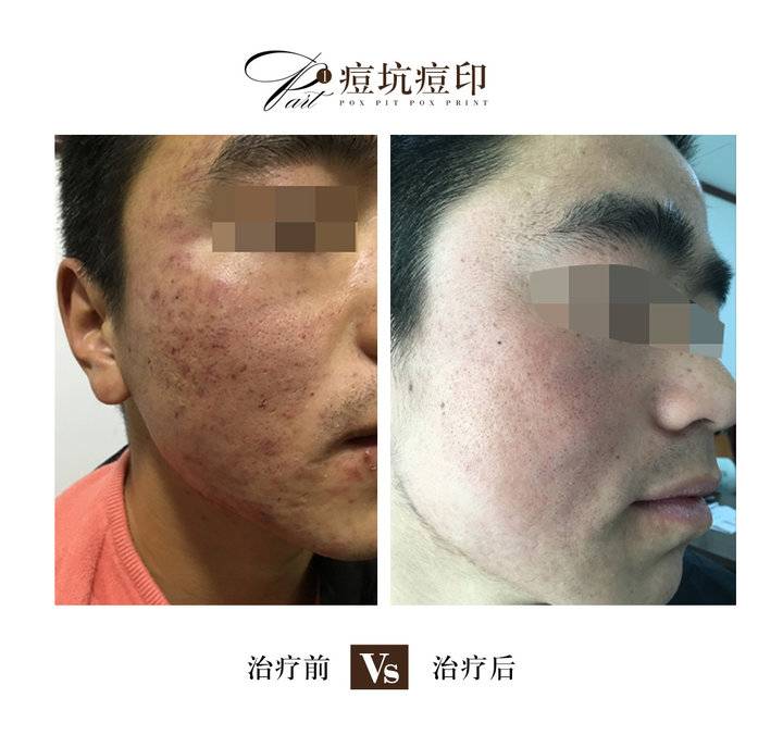 为什么痤疮脓包一直反复长,痤疮形成的痘坑如何处理