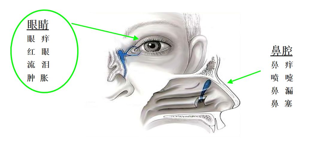 过敏性鼻炎日常生活需要注意什么,过敏性鼻炎平时饮食要注意什么