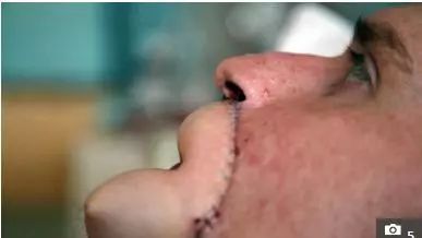 男子被恙虫咬致器官衰竭,男子惨遭蟒蛇吃掉险丧命