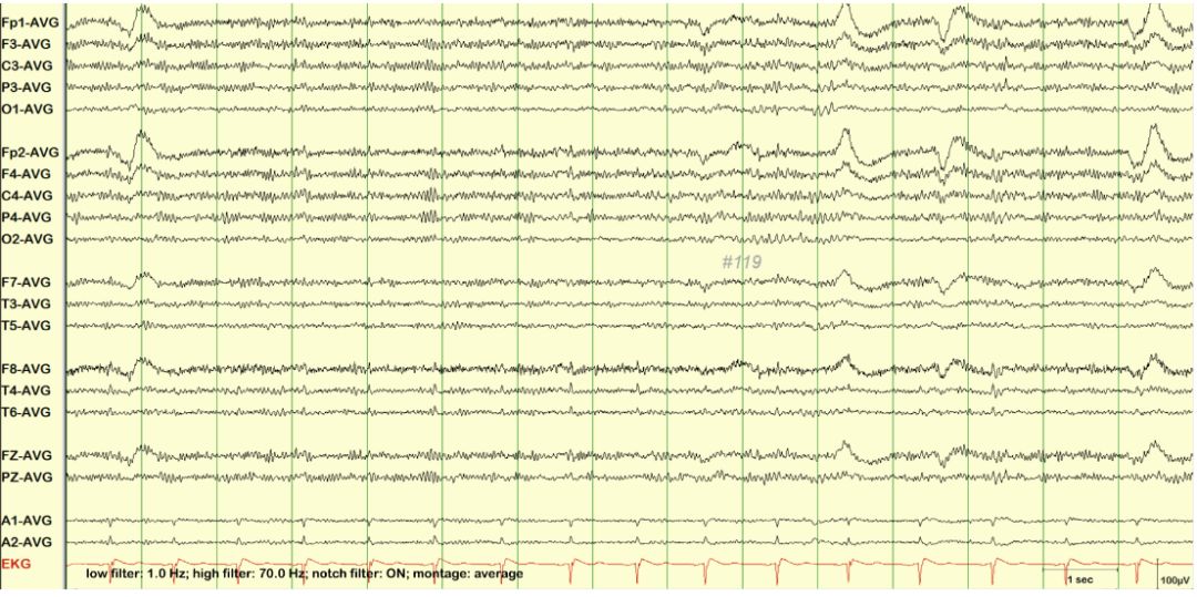 脑电图伪差图,脑电图伪差图谱