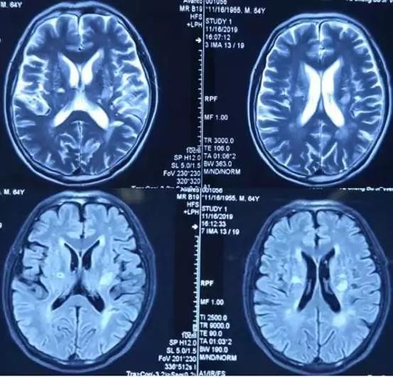 高氨血症有哪些表现,高氨血症