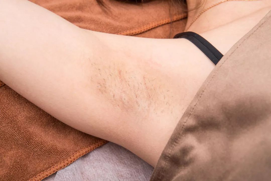 脱毛轻轻松松告别夏日尴尬,脱毛最好的季节