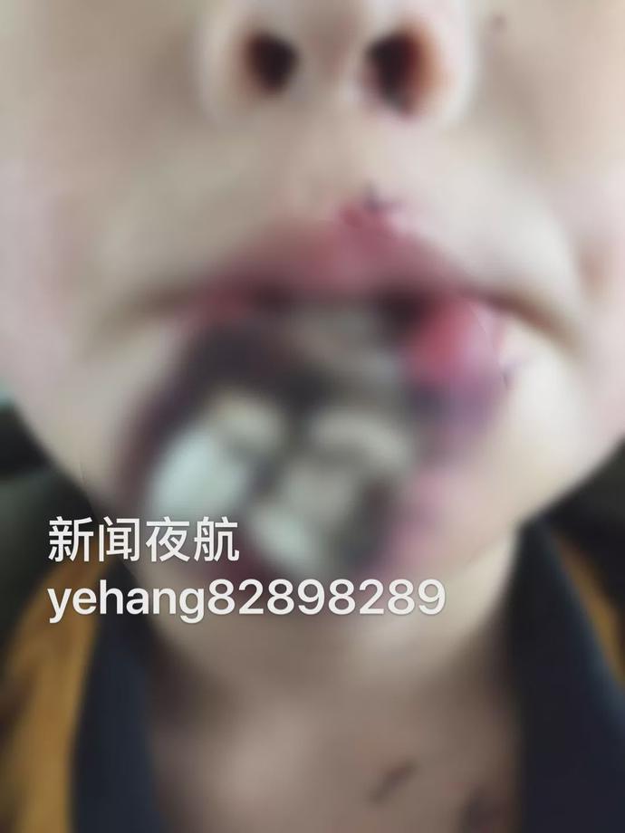 男孩模仿吃鸡死亡,男童模仿吃鸡游戏差点毁容