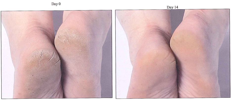 拯救手脚干裂,拯救起皮护肤品