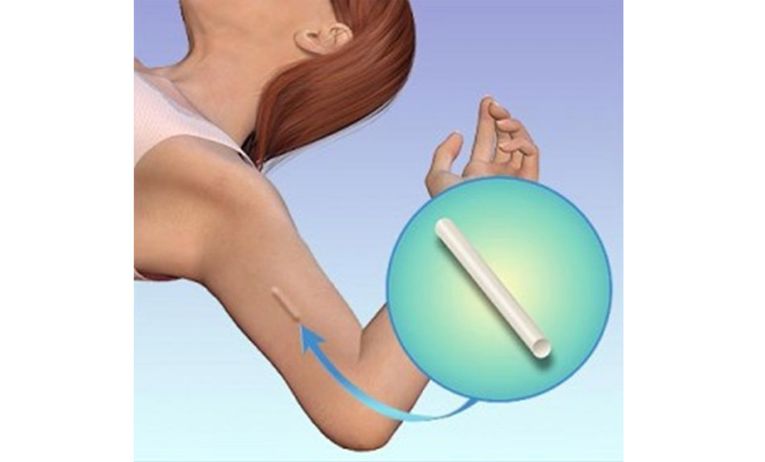 产后避孕知识及注意事项,母婴科普注意事项