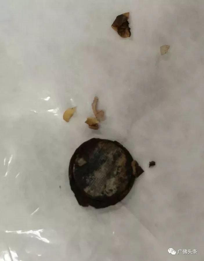 七岁男孩烧伤食道,宝宝食道被火碱烧伤会不会痊愈