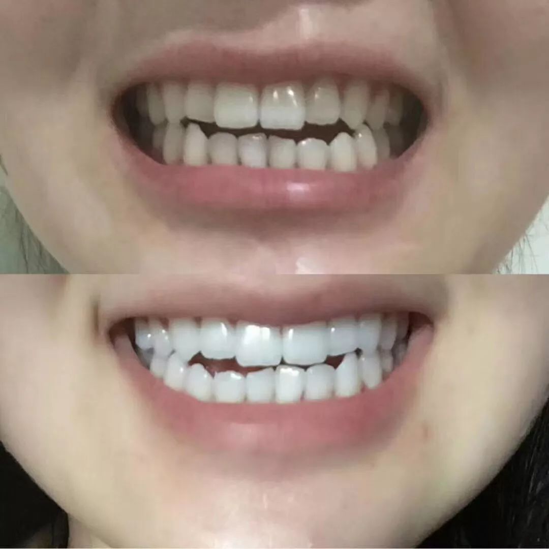 牙医推荐电动牙刷暴力测评,德国牙医推荐的变态牙刷