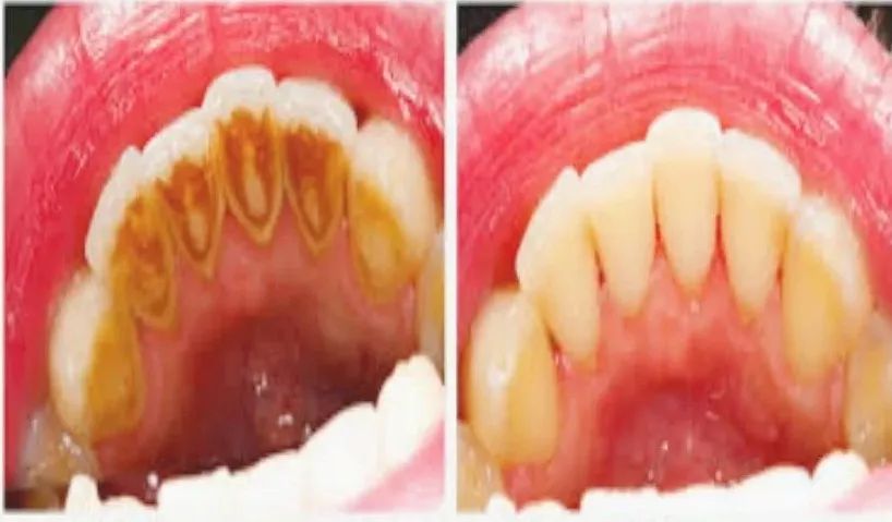 牙医推荐电动牙刷暴力测评,德国牙医推荐的变态牙刷