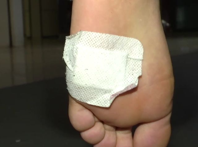 左脚小脚趾肌腱被玻璃割断,小伙脚底疼痛难受去修脚店修脚