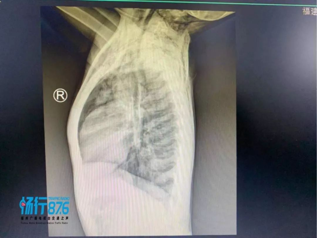 福州一男童上半身充斥气泡，作为家长，值得警醒