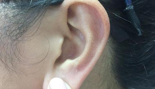 女孩因为打耳洞做手术,23岁女孩打耳洞