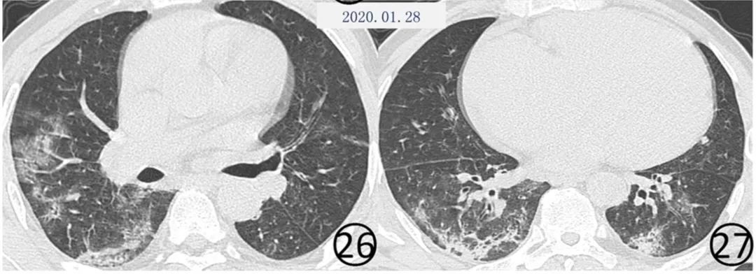 新冠肺炎影像演变过程,新冠肺炎胸部影像学特点有哪些