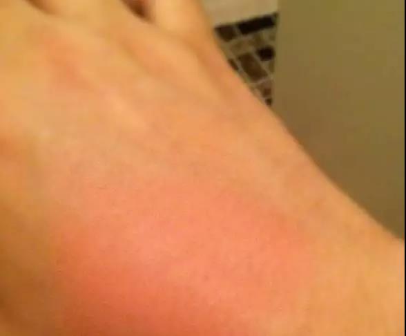 穿着衣服被开水烫伤急救,开水烫伤的急救措施