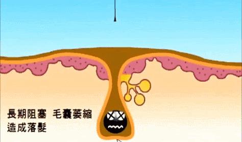 头上的螨虫用什么方法消除,头上又油又痒