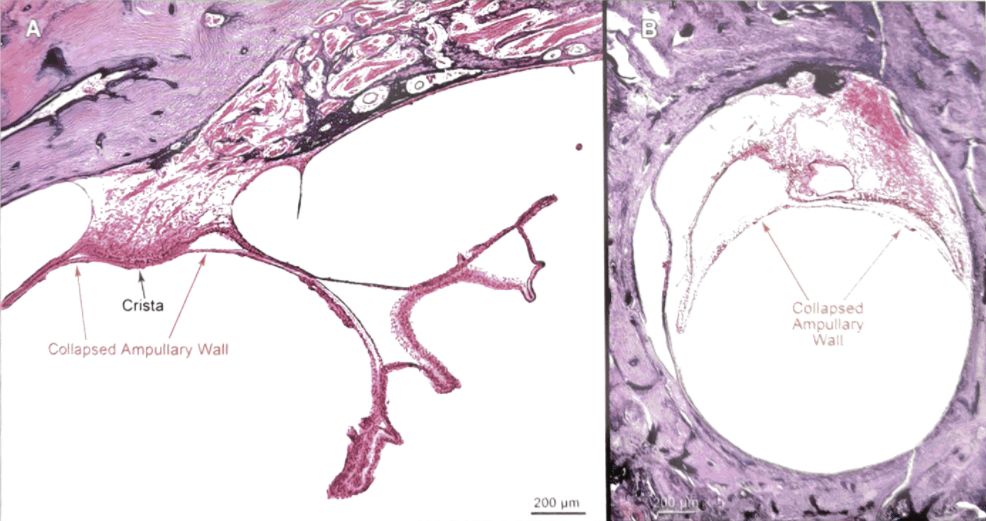 梅尼埃病深度解析,梅尼埃病病理解剖