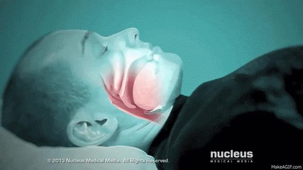 睡眠呼吸暂停的临床意义,肥胖睡眠呼吸暂停综合征