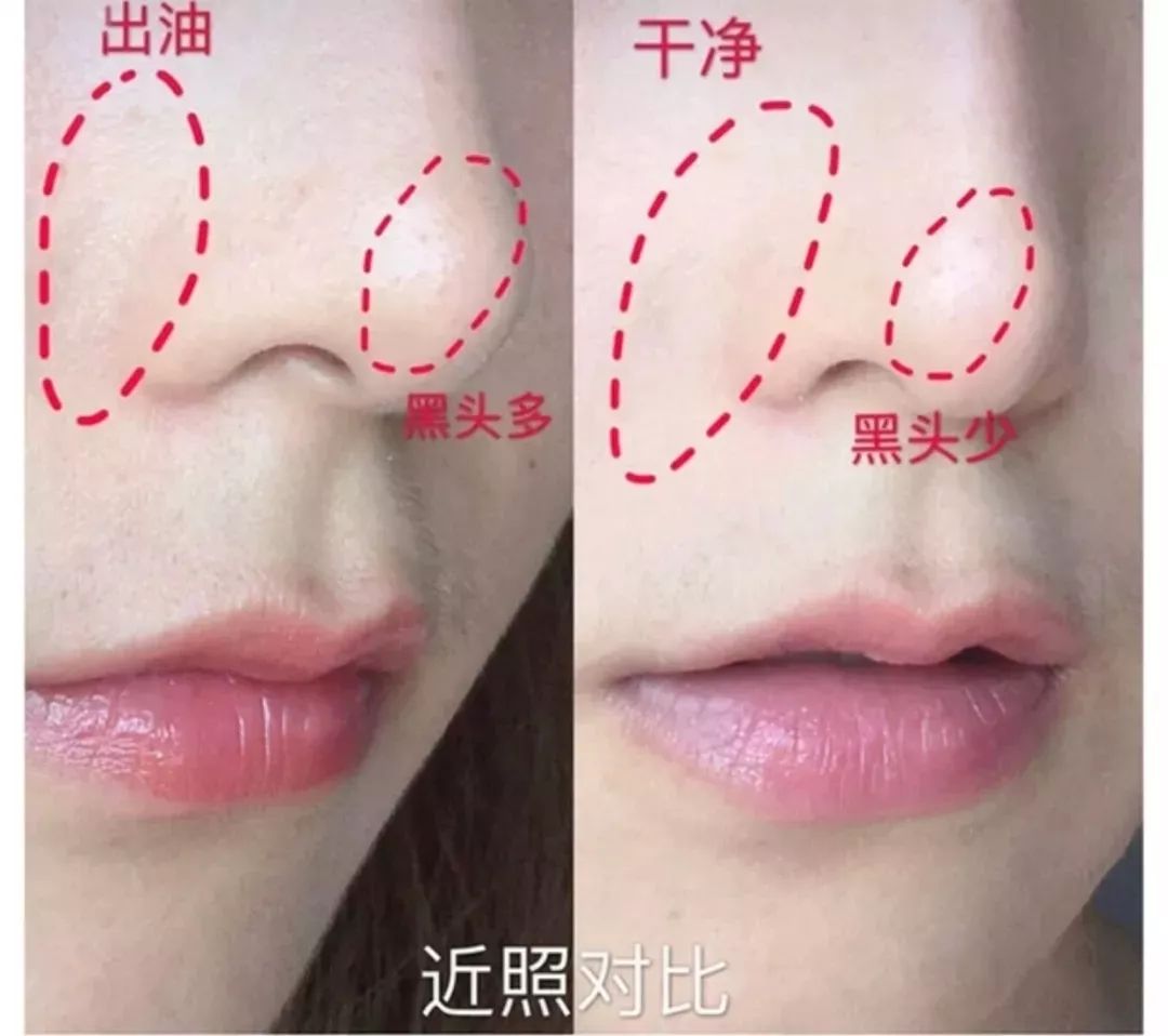 10鍒嗛挓娓呴櫎榛戝ご绮夊埡,榛戝ご绮夊埡鎸ゅ帇娓呯悊姣涘瓟绮楀ぇ