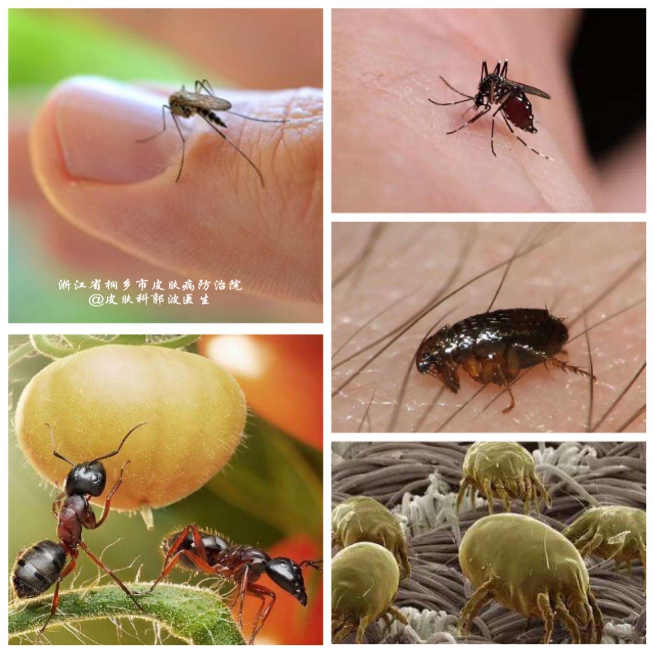 丘疹性荨麻疹最佳治疗方法,丘疹性荨麻疹防治措施